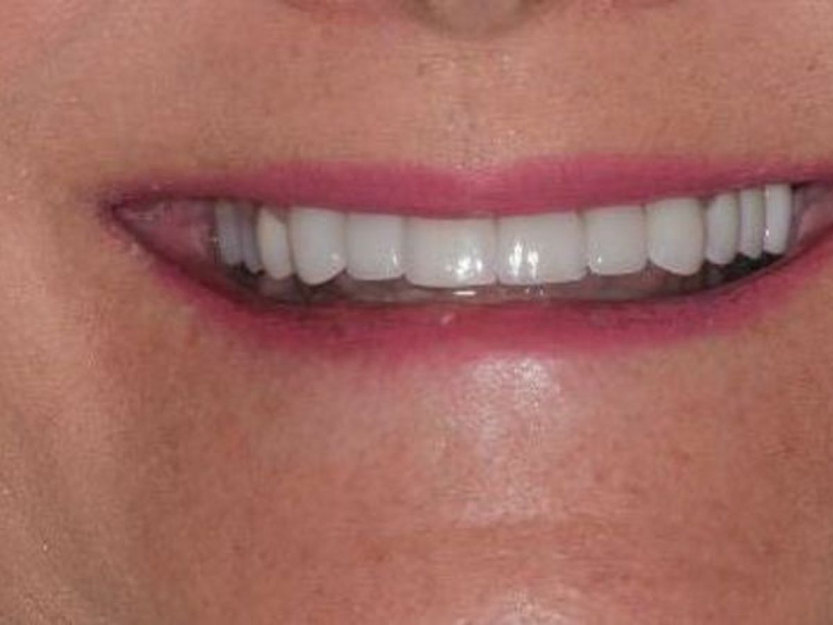 Dental Crowns: Case 26 — after