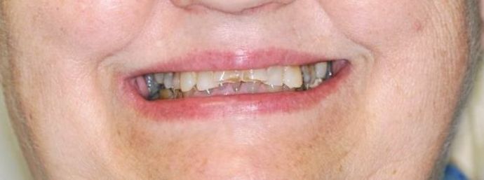 Full Mouth Reconstruction: Case 3 — before