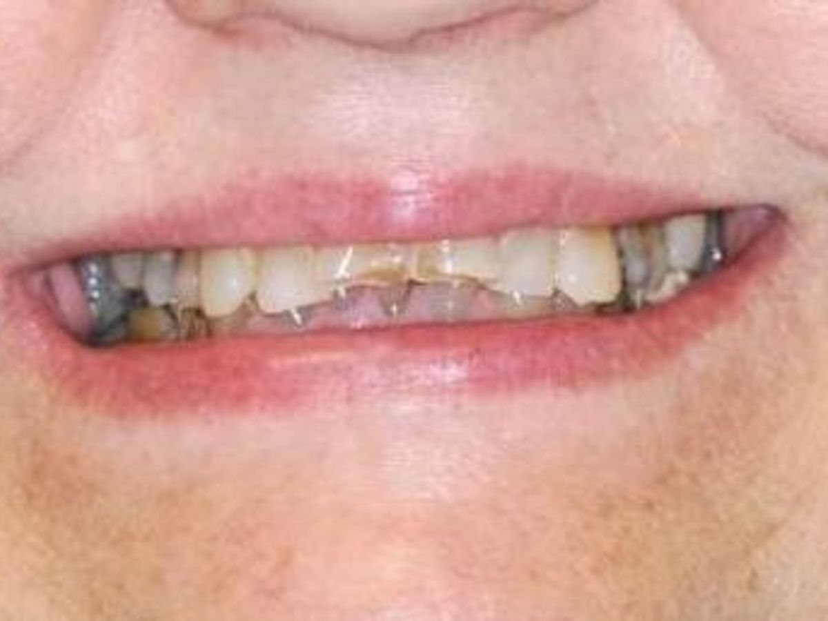 Full Mouth Reconstruction: Case 3 — before