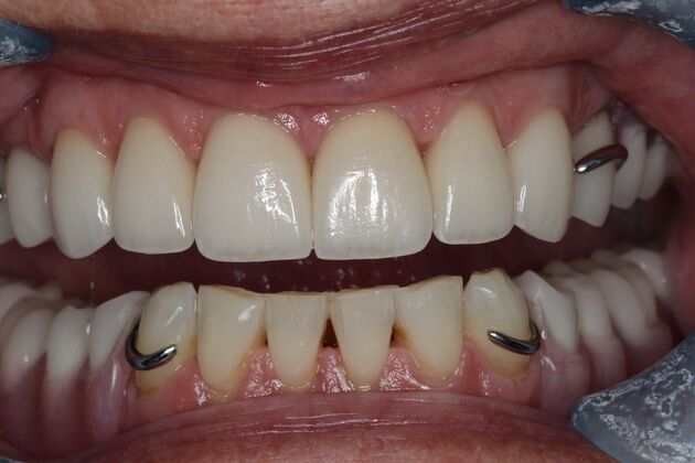 Dentures: Case 15 — Upper Crowns and Partial after