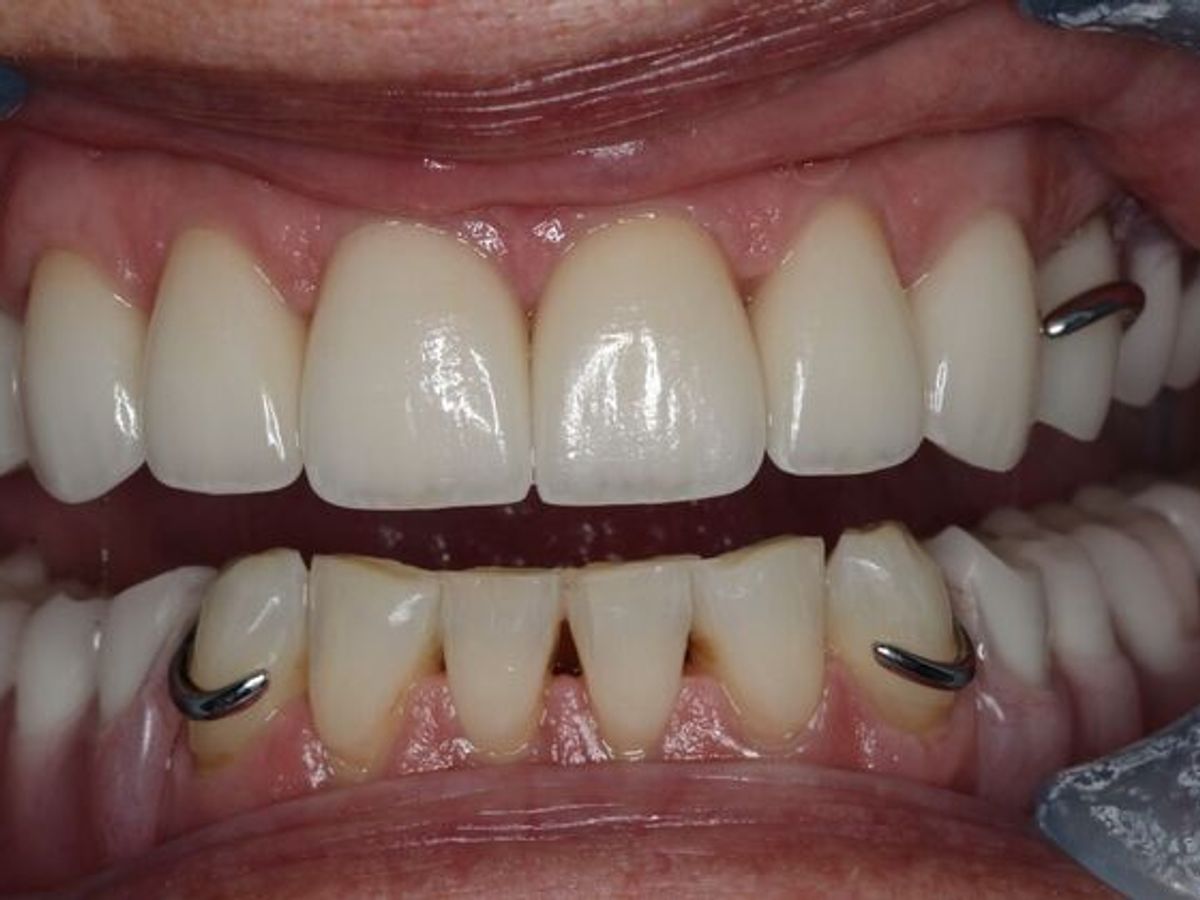 Dentures: Case 15 — Upper Crowns and Partial after