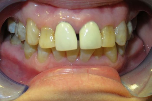 Dental Crowns: Case 7 — before