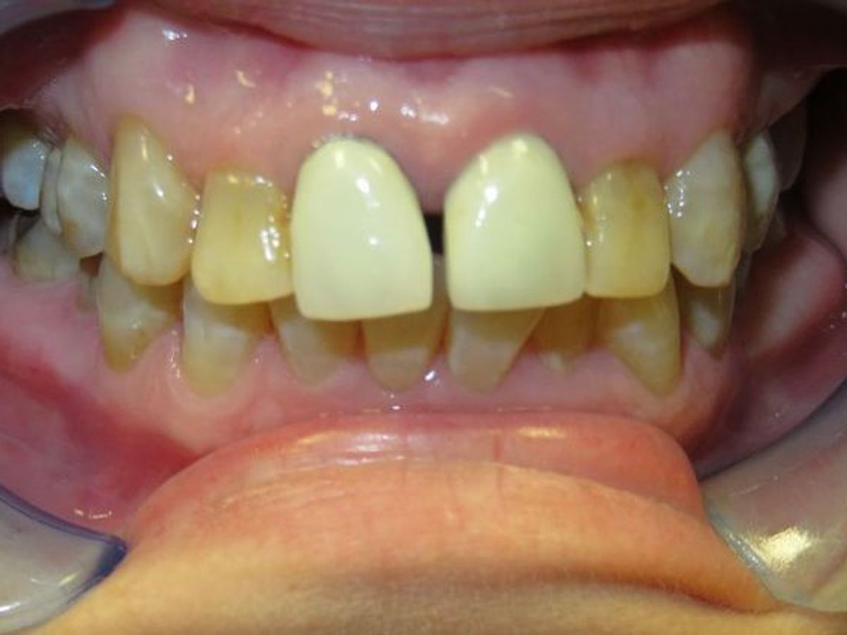 Dental Crowns: Case 7 — before