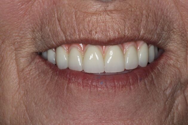 Teeth in a Day: Case 28 — after