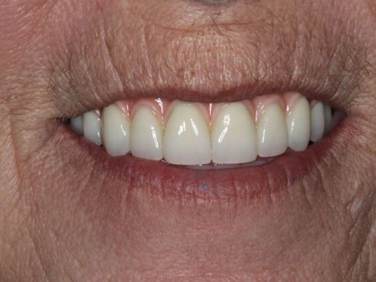 Teeth in a Day: Case 28 — after