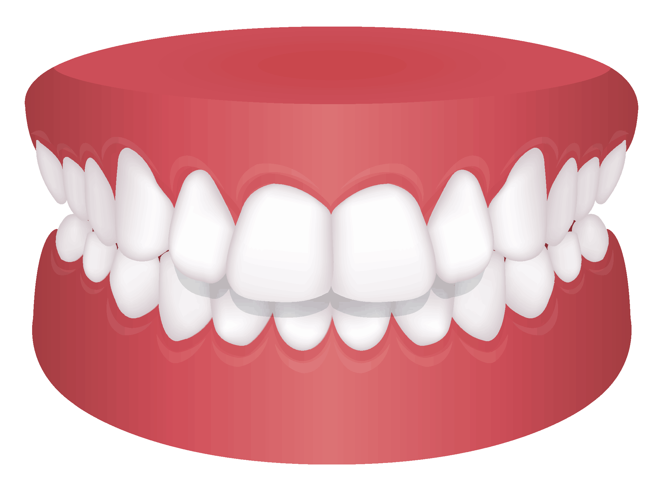 overbite diagram