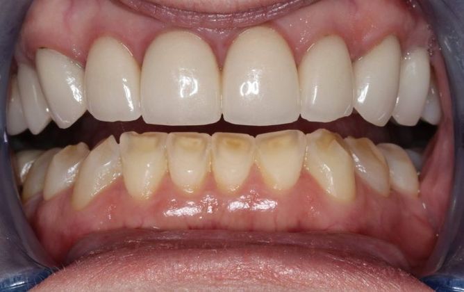 Veneers: Case 13 — before