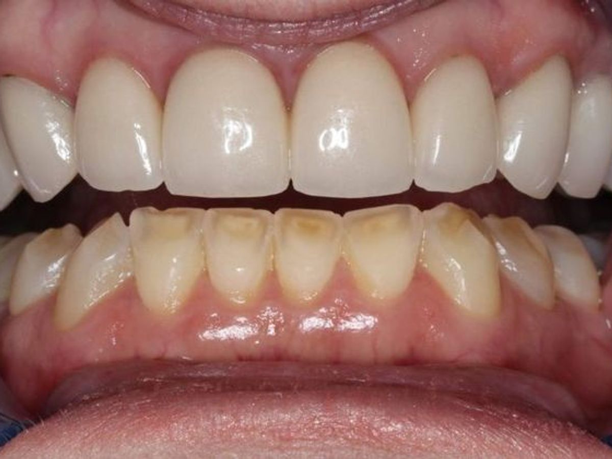 Veneers: Case 13 — before