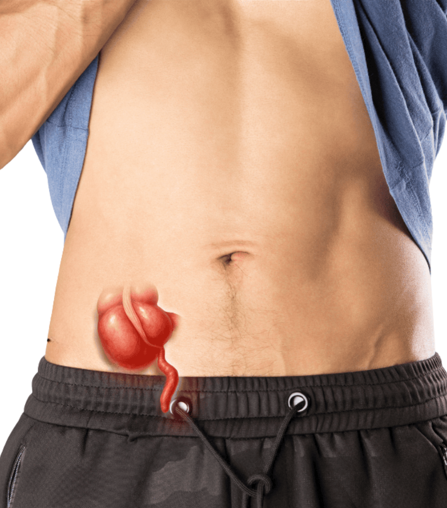 Appendicitis illustration showing inflamed appendix in lower right abdomen with pain location