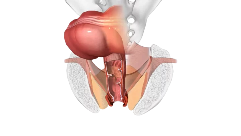 Treat Faecal Incontinence