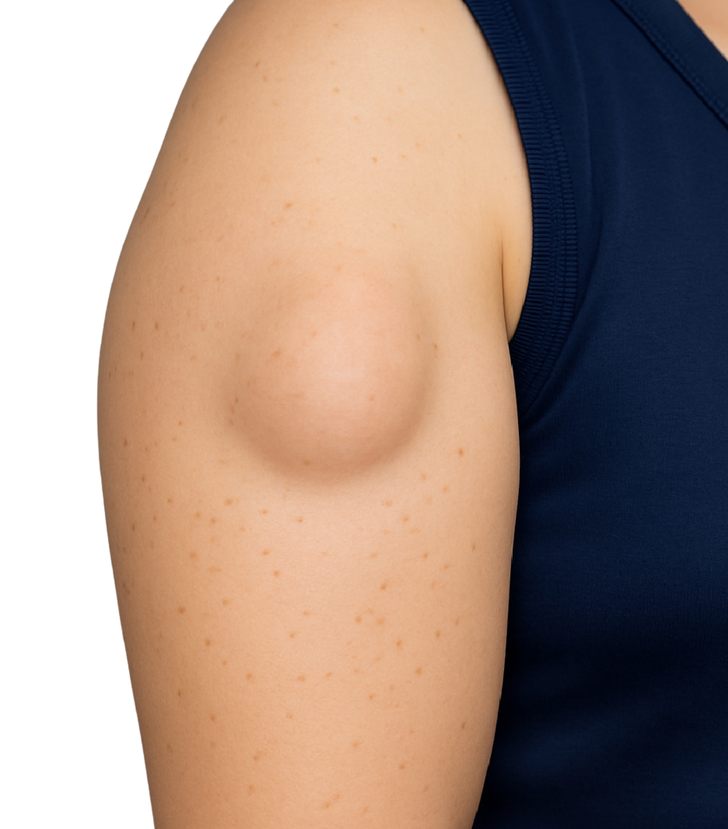 Lipoma removal surgery by Dr. Tejasree Vengala general surgeon Hyderabad