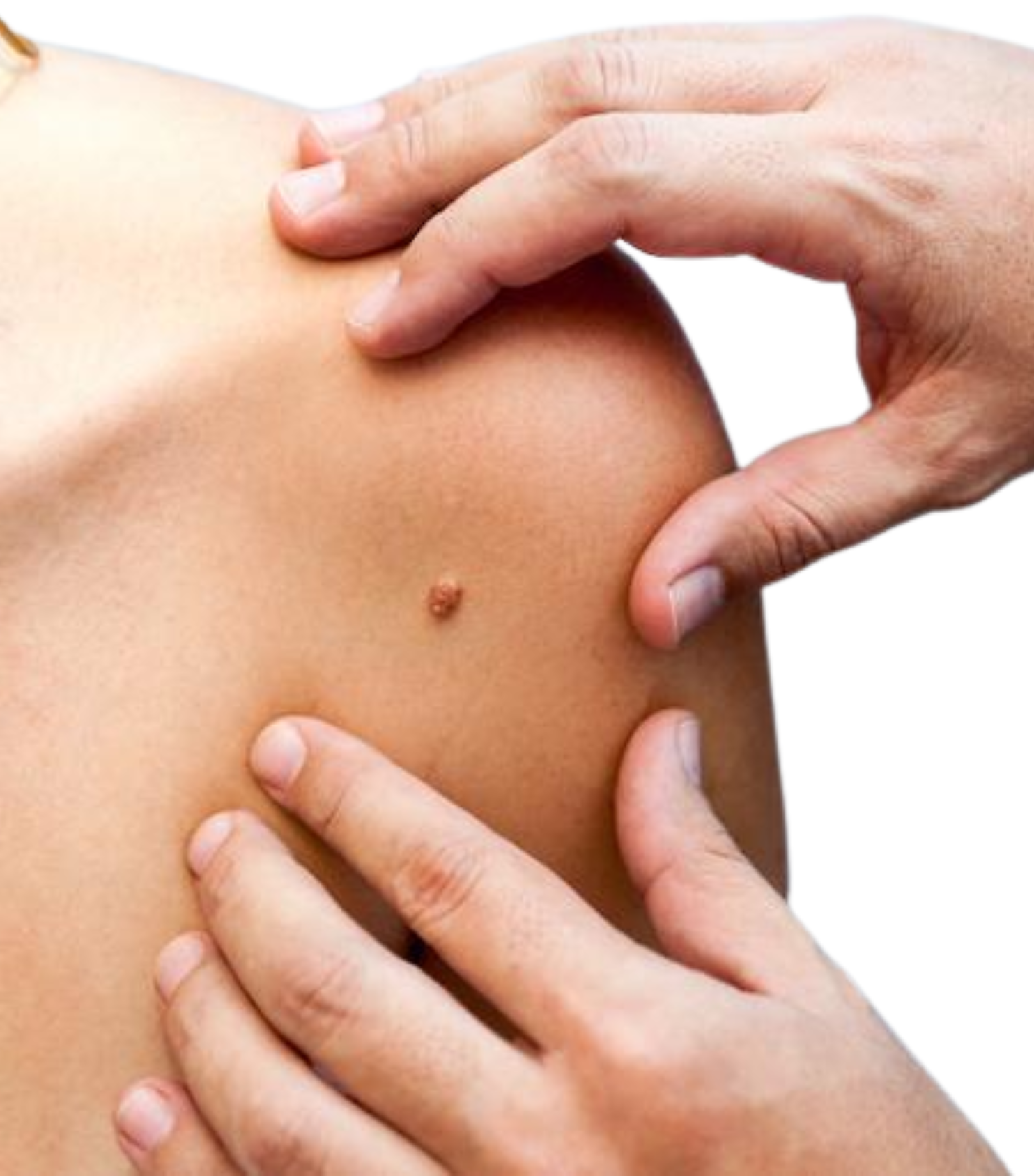 Skin tumor removal by Dr. Tejasree Vengala specialist surgeon Hyderabad