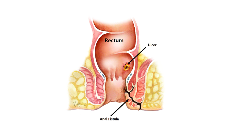 Fistula Surgery Cost in Hyderabad
