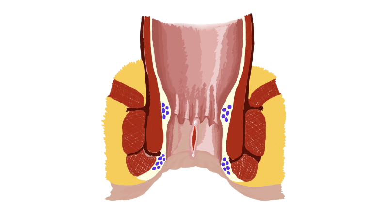 Prevent Anal Fissures
