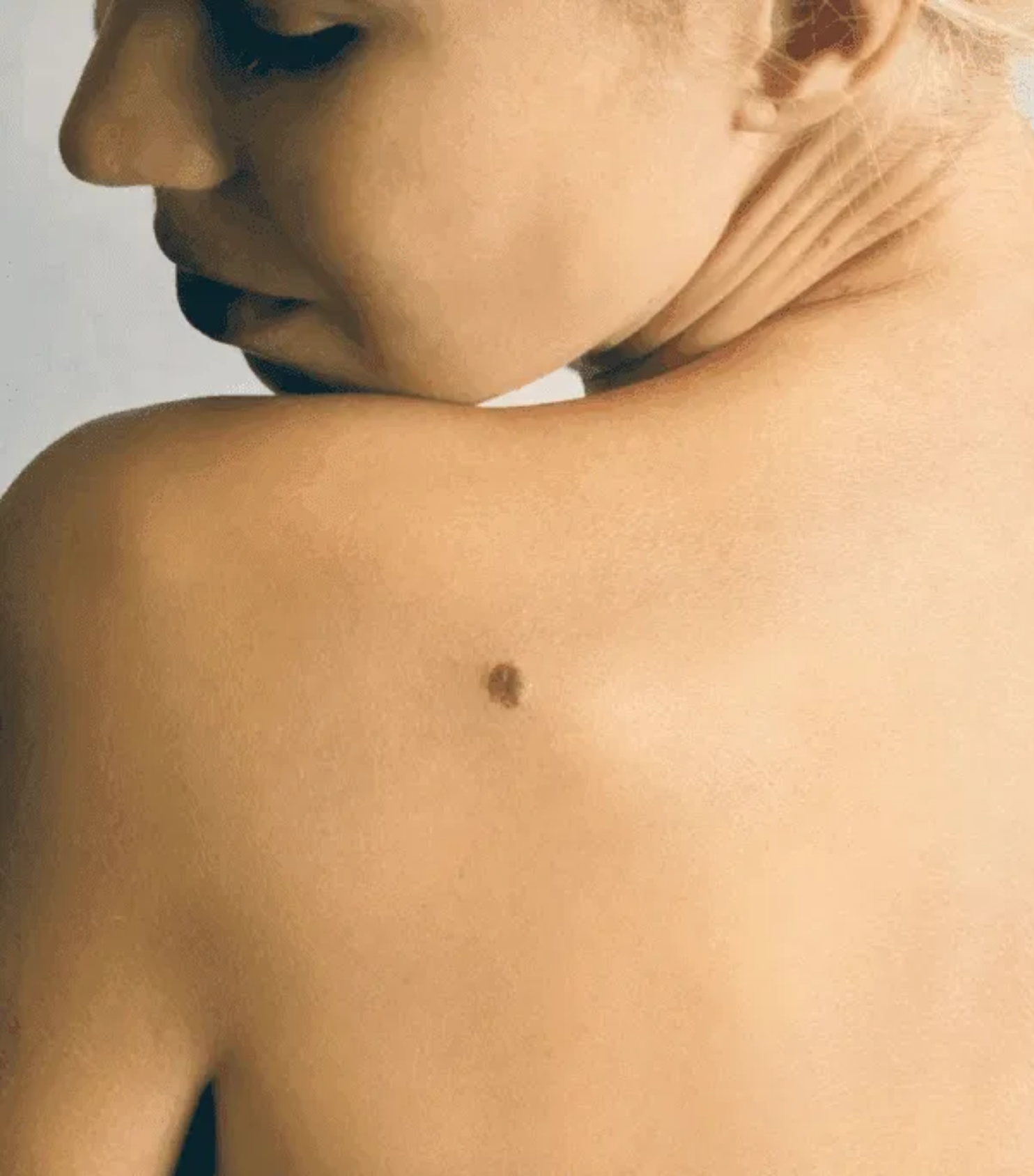 Cyst removal surgery by Dr. Tejasree Vengala specialist surgeon Hyderabad