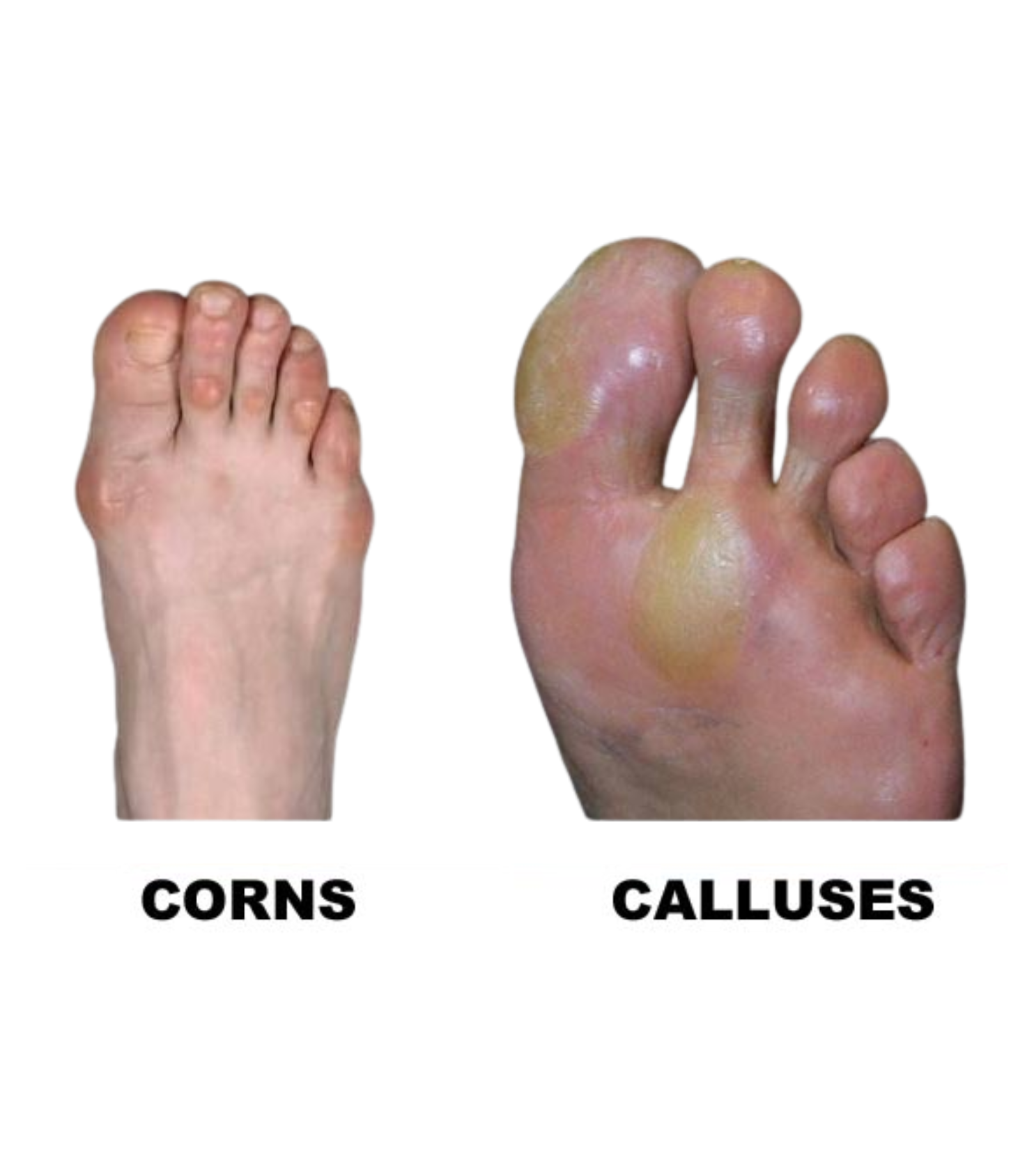 Corn removal treatment by Dr. Tejasree expert surgeon Hyderabad