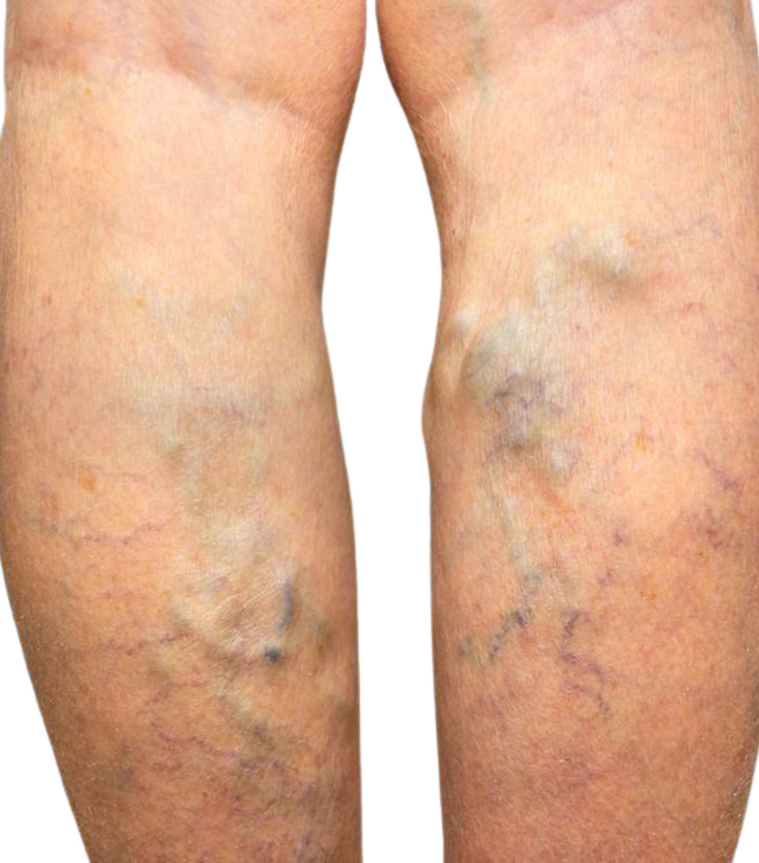Varicose veins treatment laser surgery by Dr. Tejasree Hyderabad
