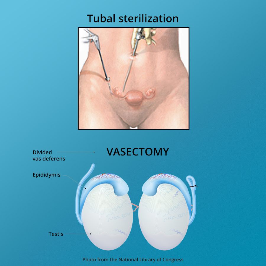 Vasectomy