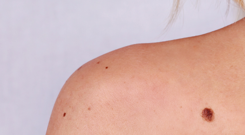 picture of a mole on a shoulder