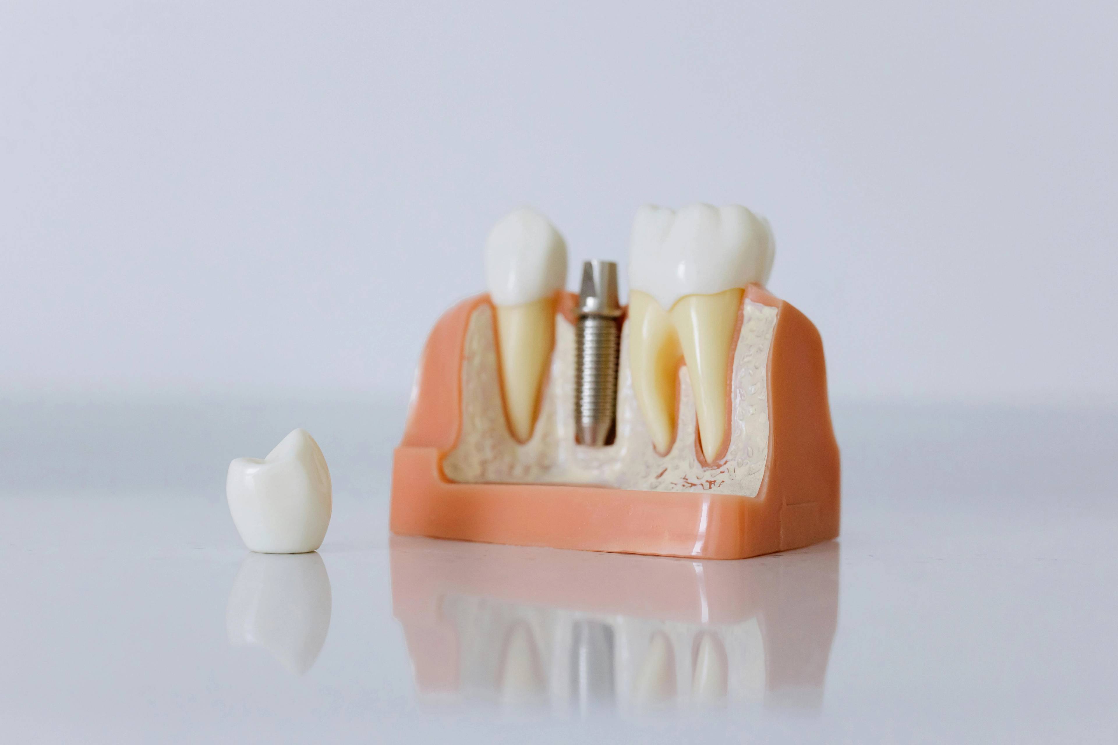A stock photo of a model of a jawbone with a single dental implant in the middle and a crown next to it ready to cover the implant