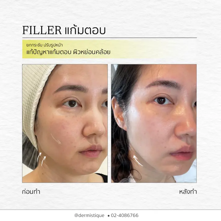 Skin Booster 4