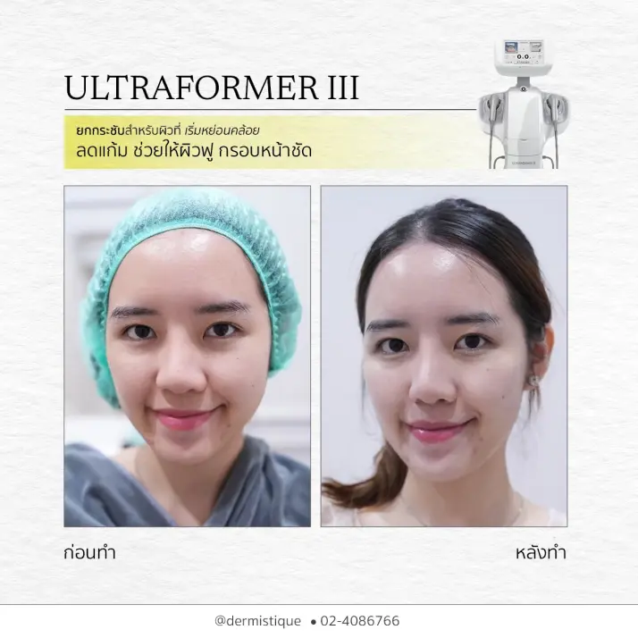 Skin Booster  3