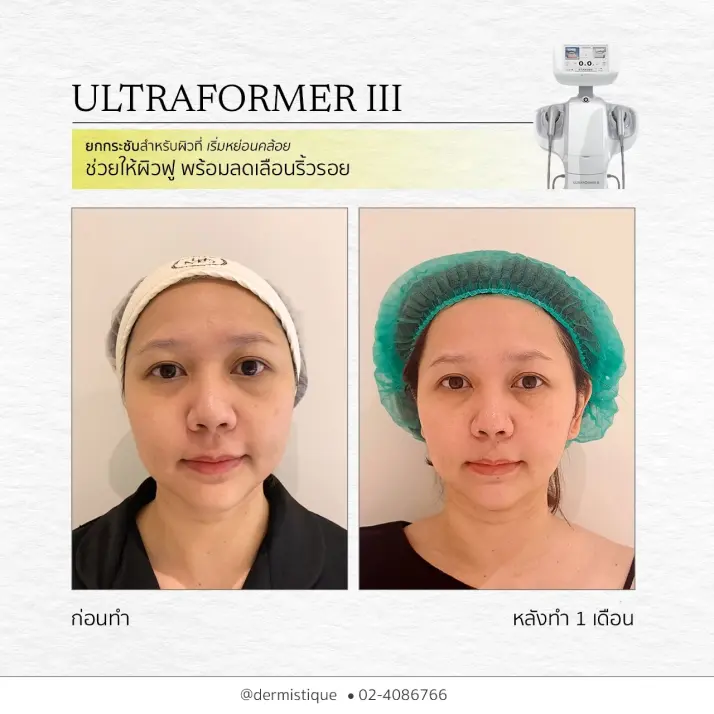 Skin Booster 1