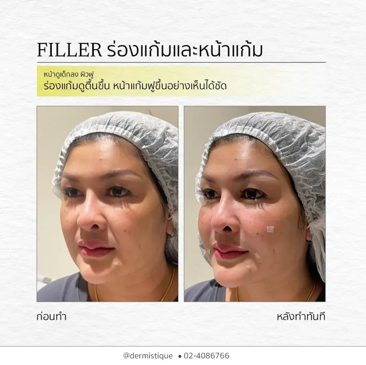 Skin Booster 6