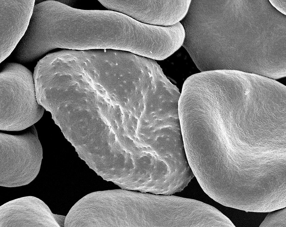 $3.3B Funding Gap: When Donor Fatigue Meets Africa's Deadliest Disease