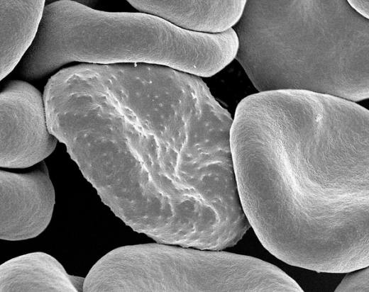 $3.3B Funding Gap: When Donor Fatigue Meets Africa's Deadliest Disease