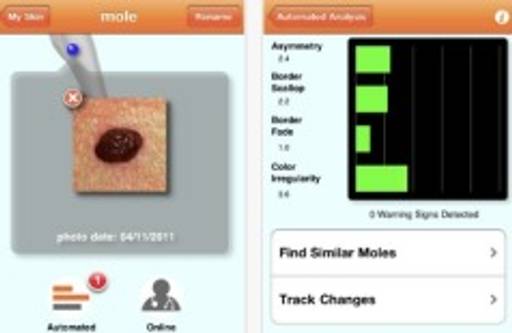 Diagnosing moles via iPhone