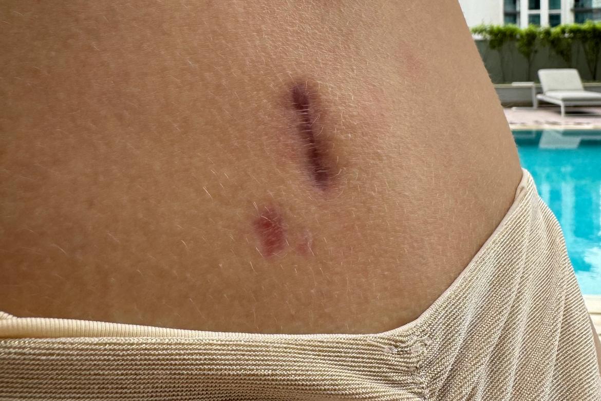 Шрам после операции. Шрам после удаления грыжи