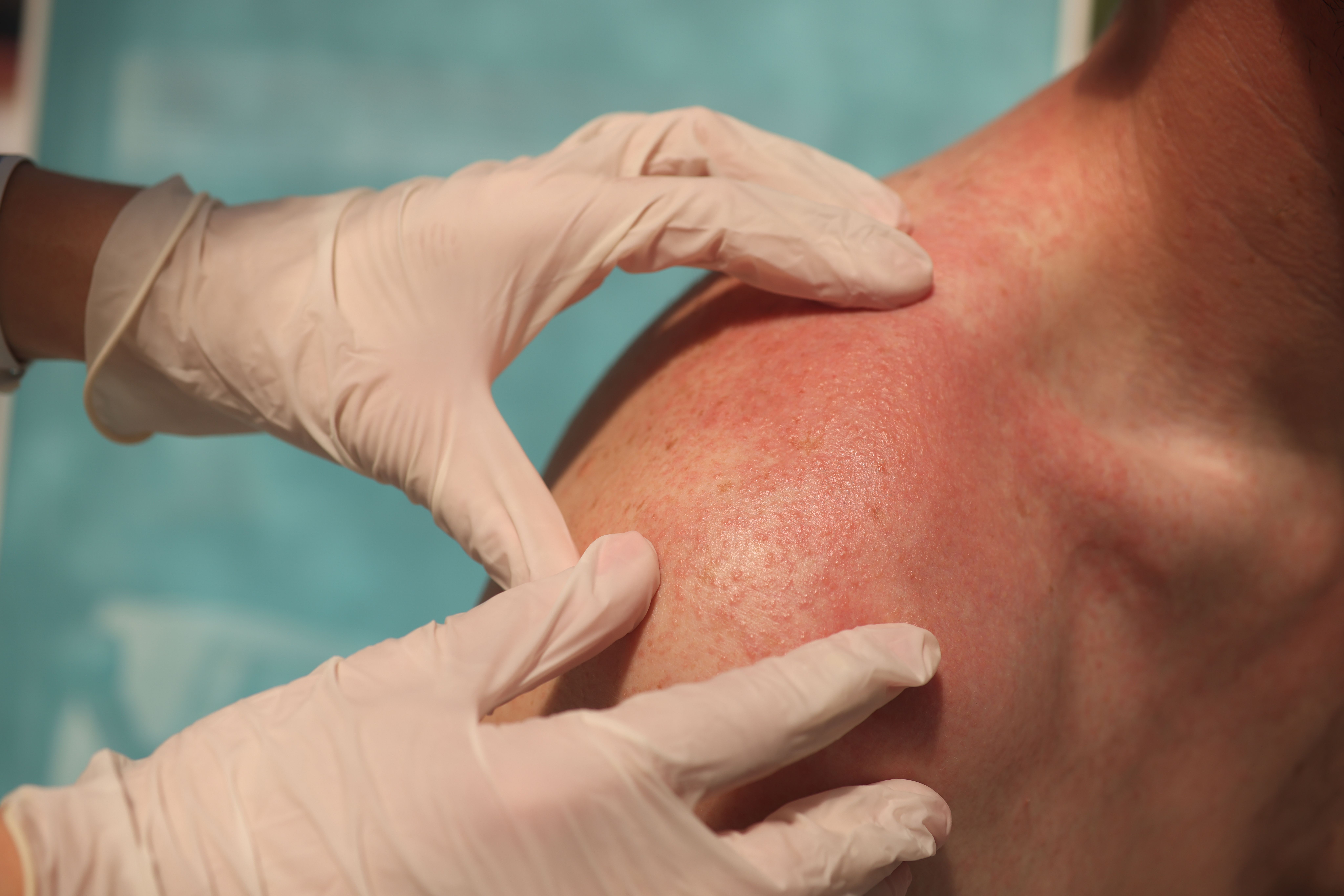 A clinician in white gloves examines a red rash across a patient's shoulder.