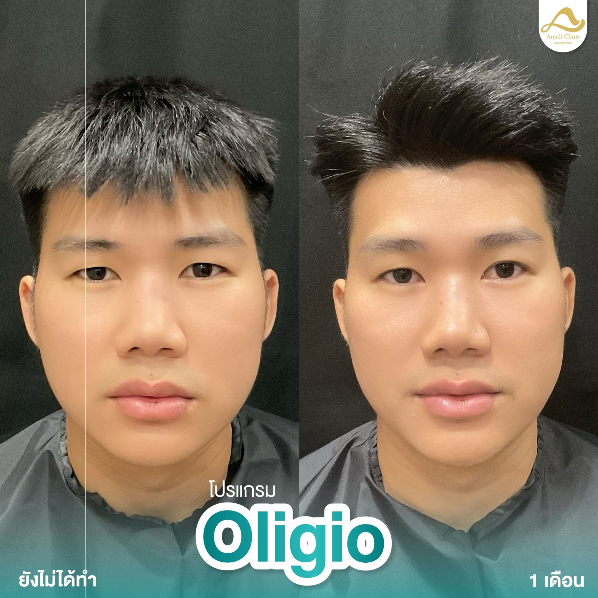 Oligio 5