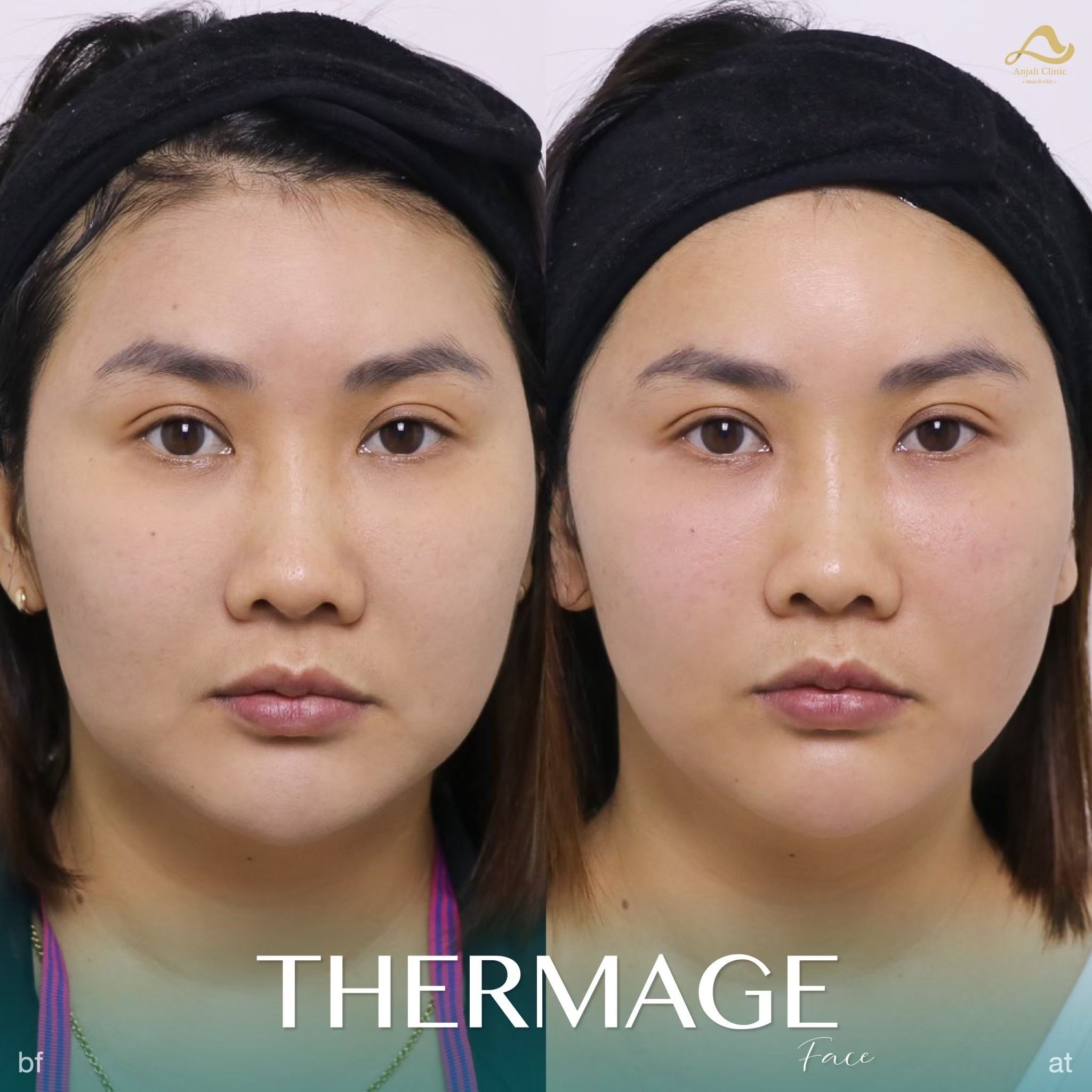 Thermage หน้า 3