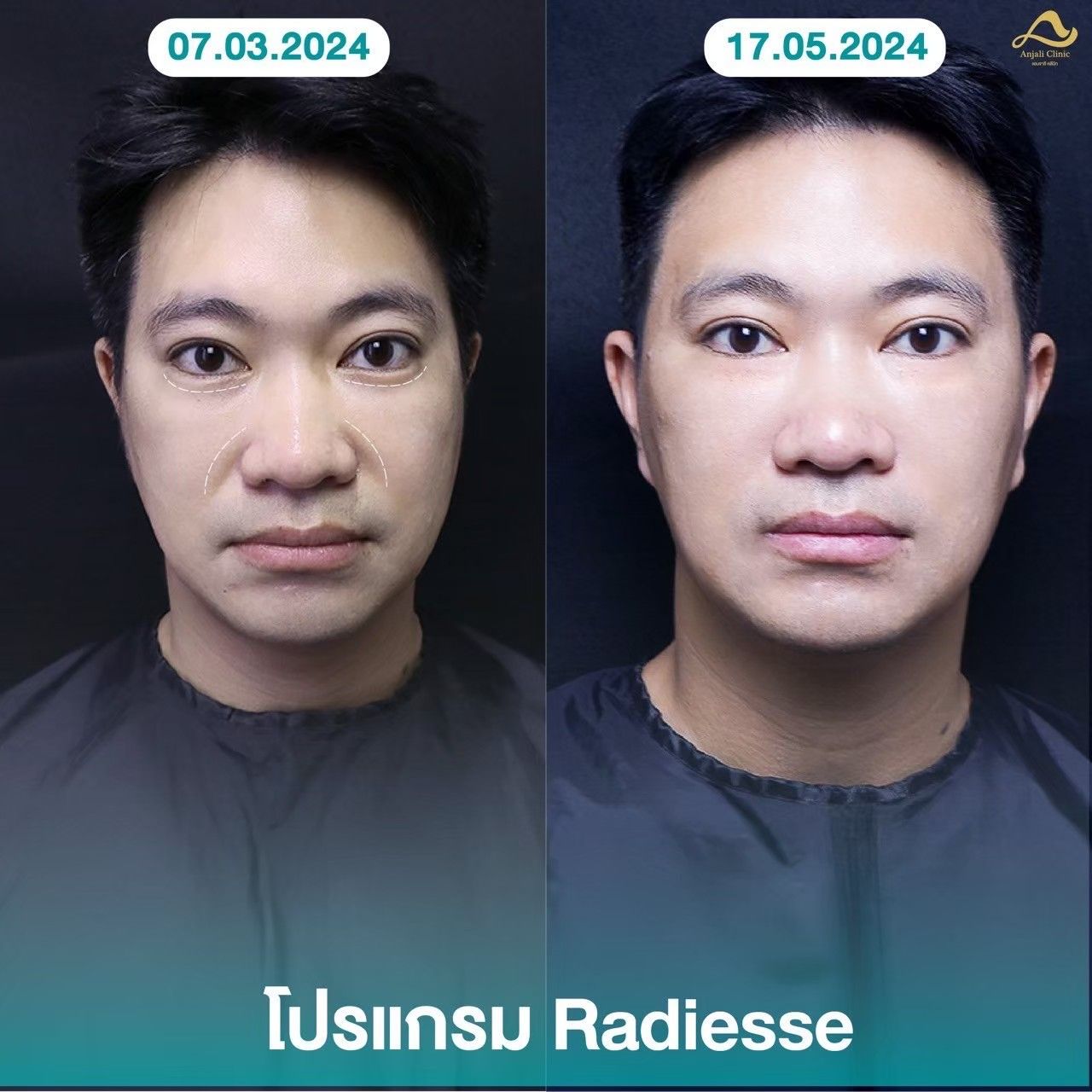 Radiesse / Radiesse + 5