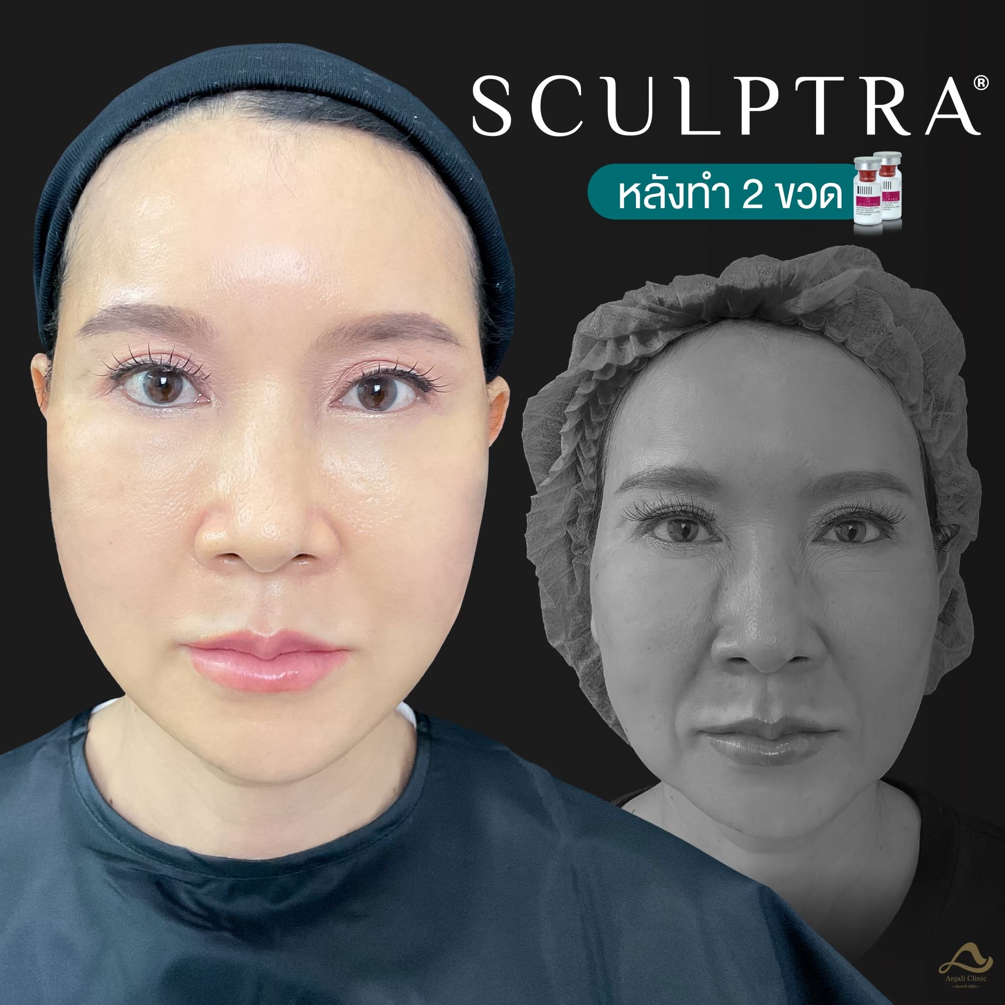Sculptra 2