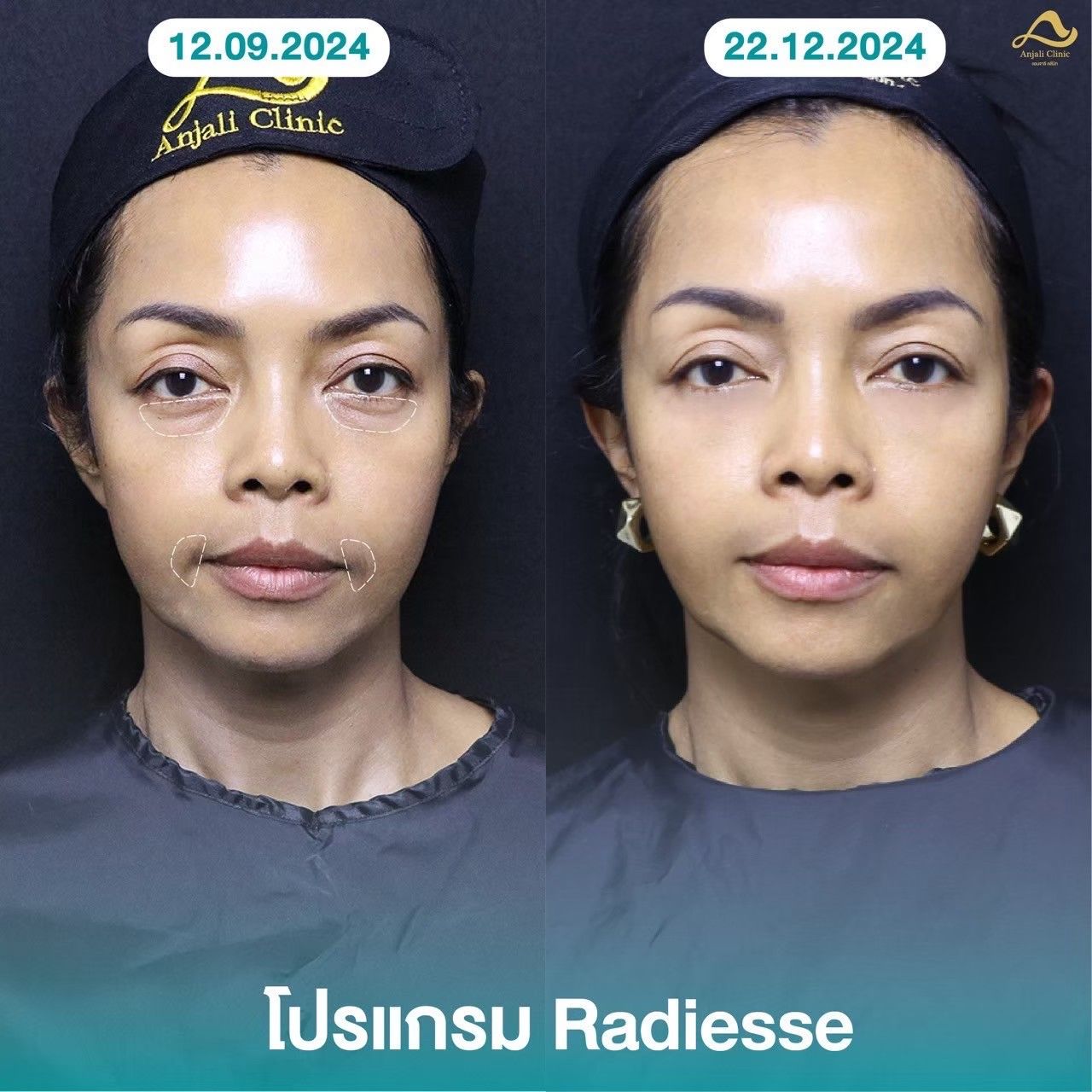 Radiesse / Radiesse + 3