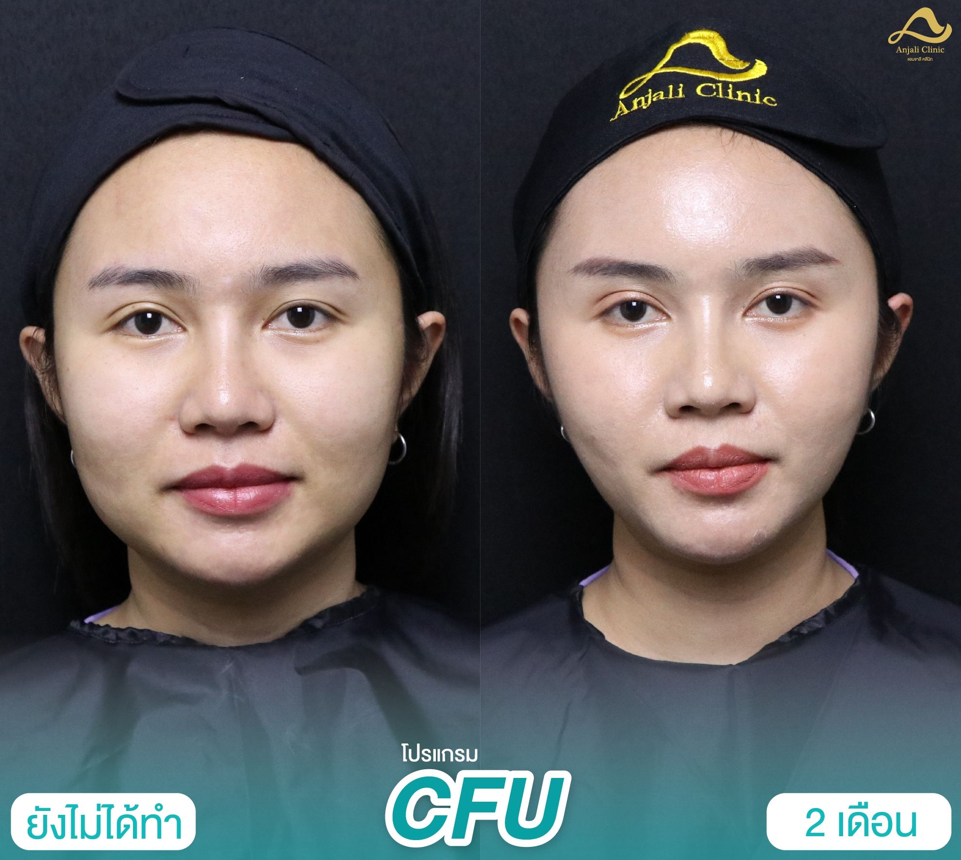 Cfu / Hifu 3