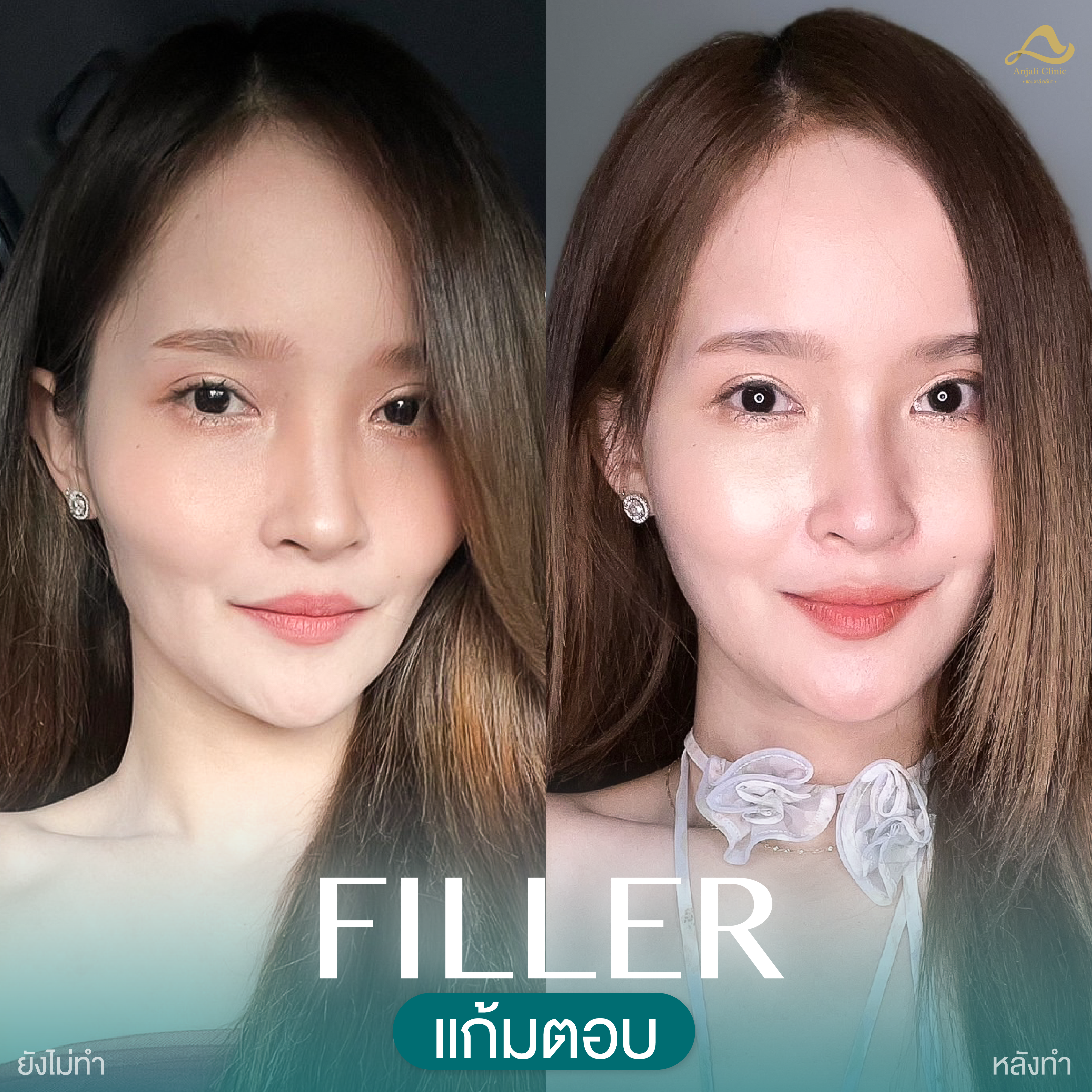 แก้ม 1