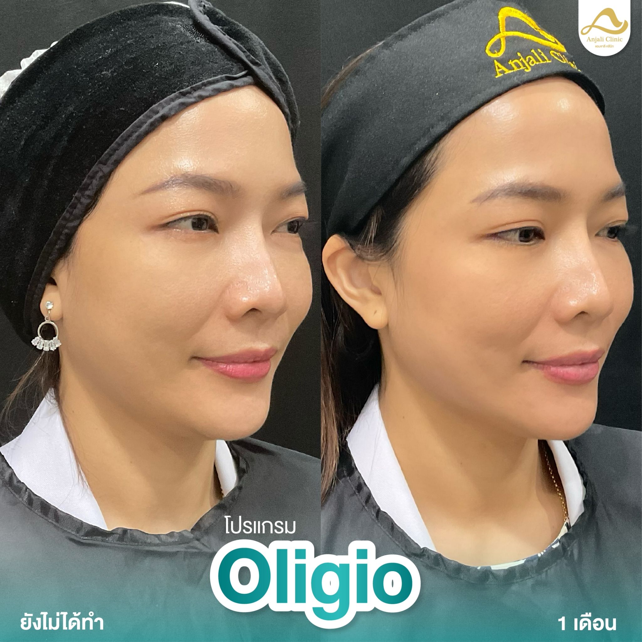 Oligio 2