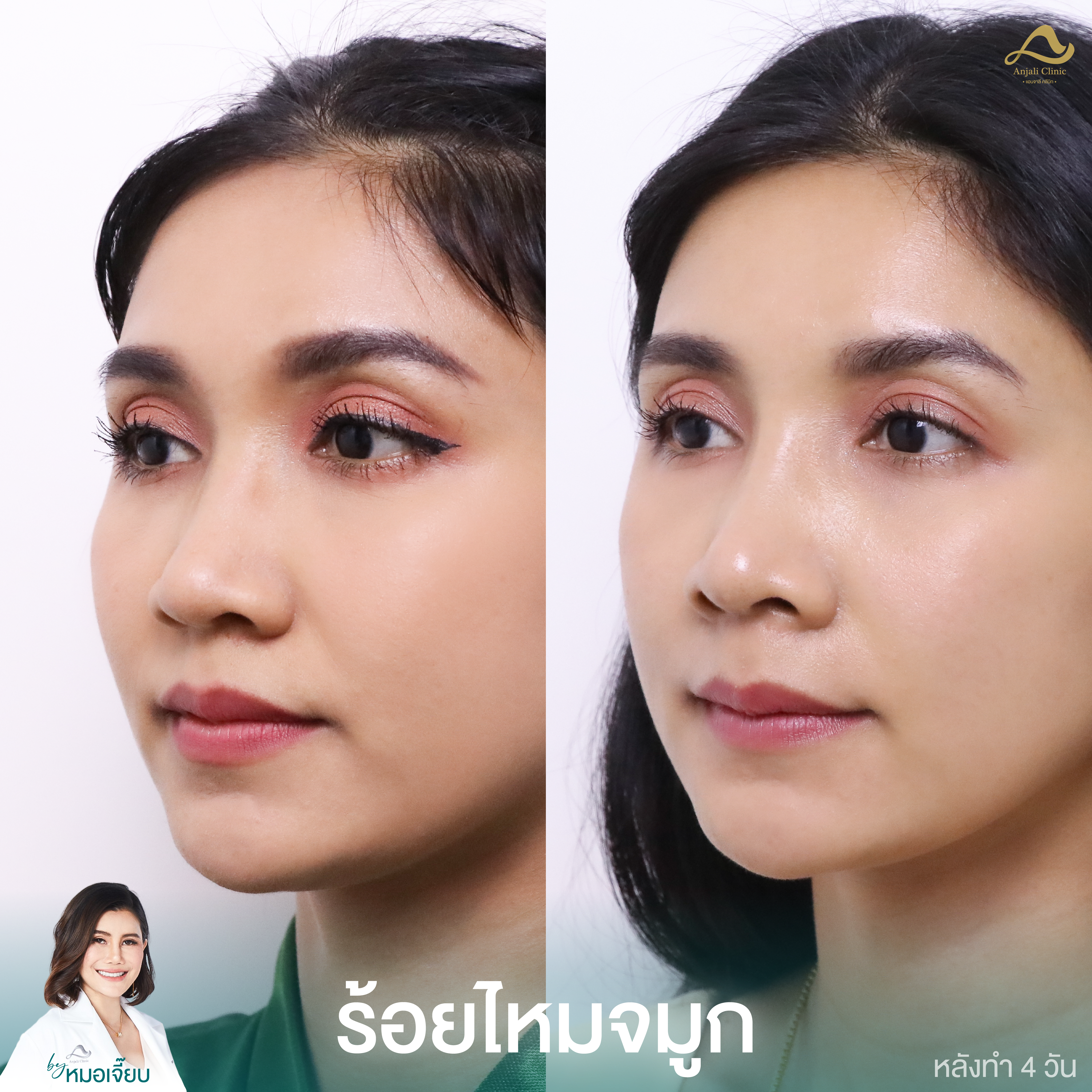 ร้อยไหมจมูก 1