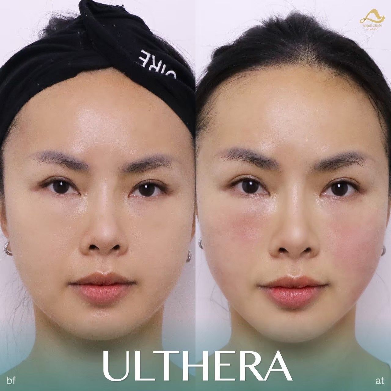 Ulthera Prime / SPT 6