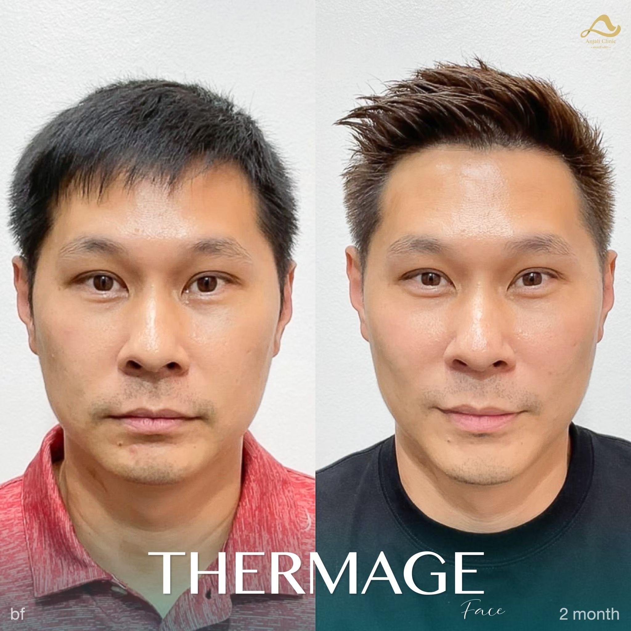 Thermage หน้า 7