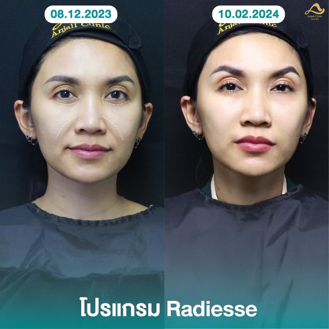 Radiesse / Radiesse + 2