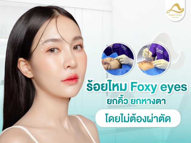 ร้อยไหม Foxy eye ยกคิ้ว ยกหางตา โดยไม่ต้องผ่าตัด