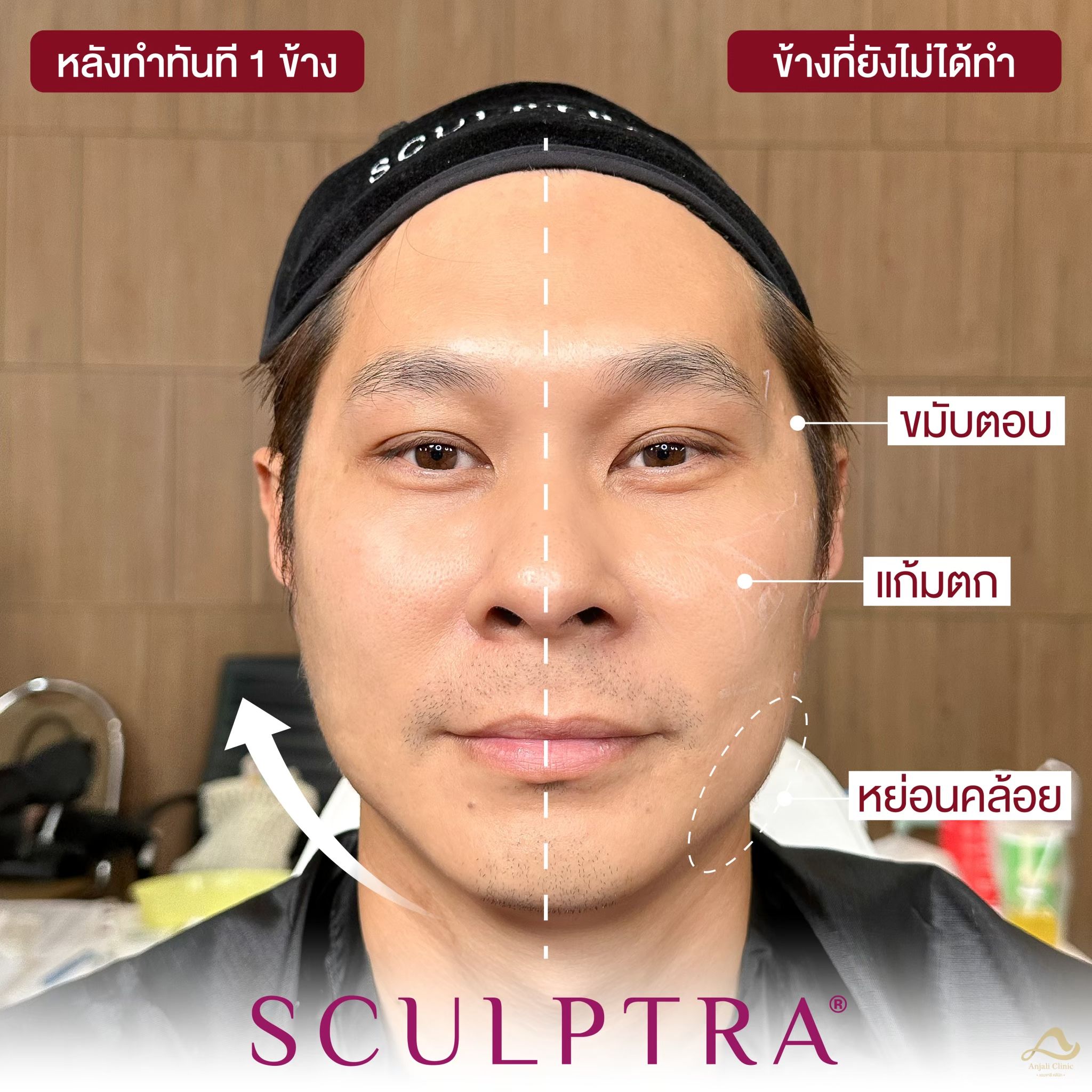 Sculptra 4