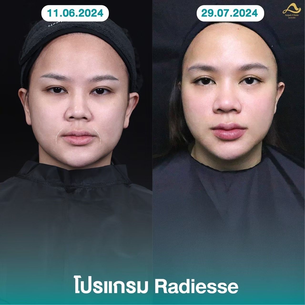 Radiesse / Radiesse + 8