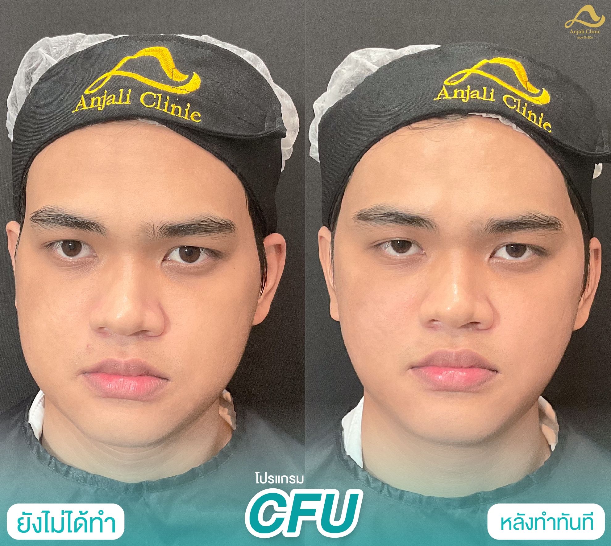 Cfu / Hifu 6