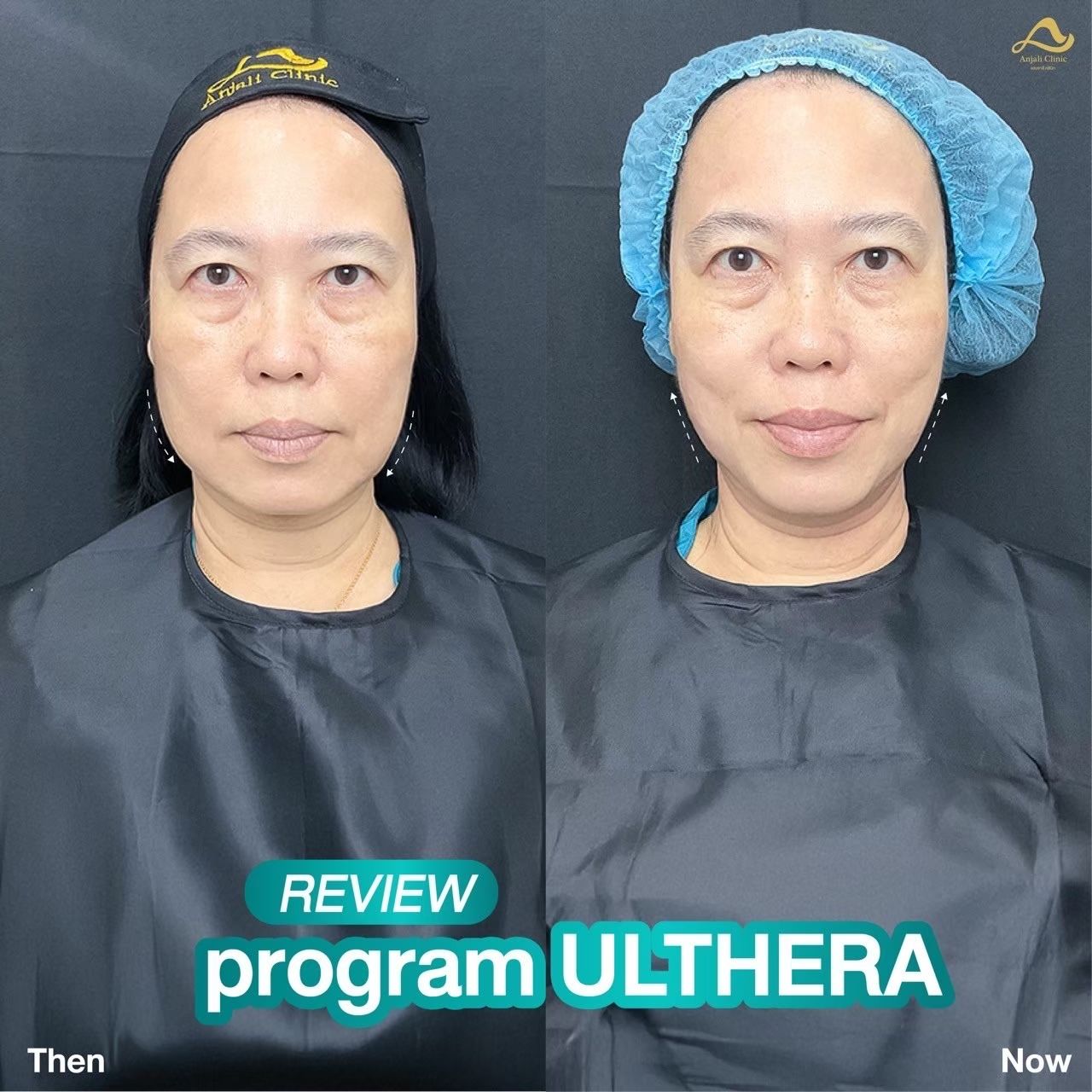 Ulthera Prime / SPT 2